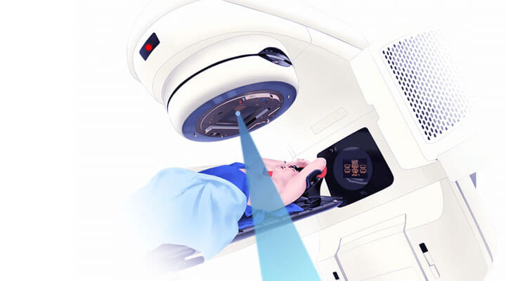 Radiotherapy for breast cancer treatment
