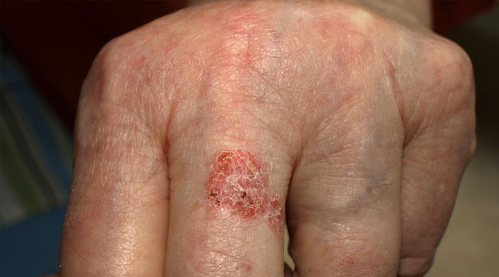 Skin cancer showing on hand