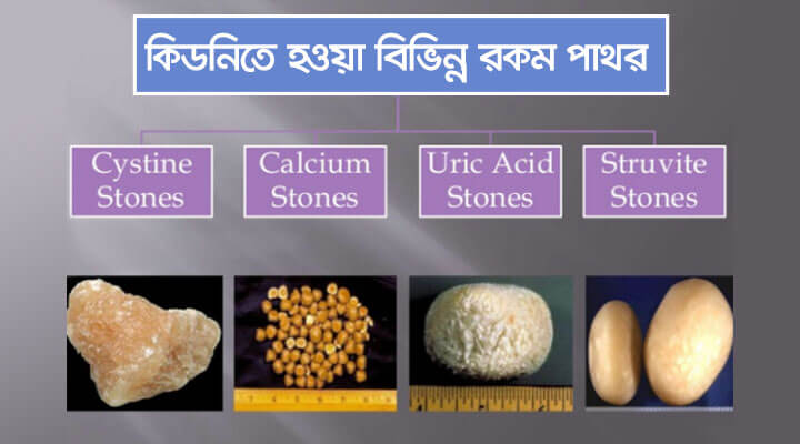 Types of kidney Stone