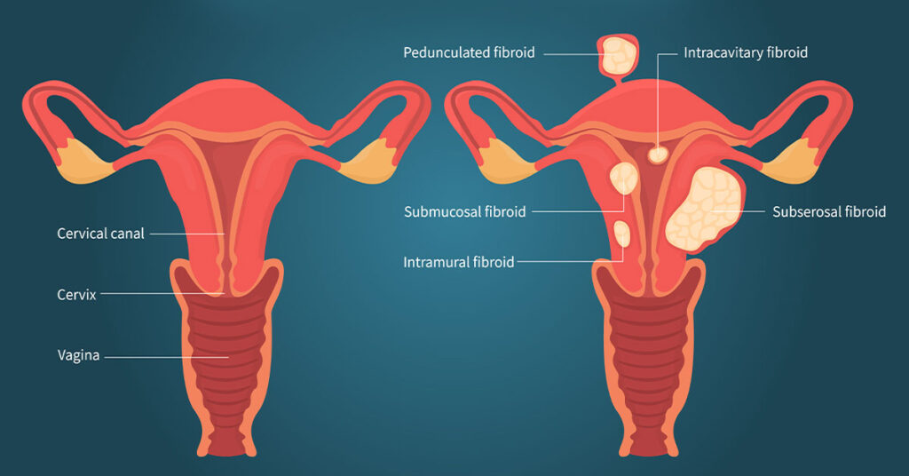types of uterine fibroids