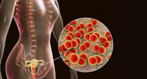 ক্ল্যামিডিয়া রোগের লক্ষণ,কারণ ও চিকিৎসা