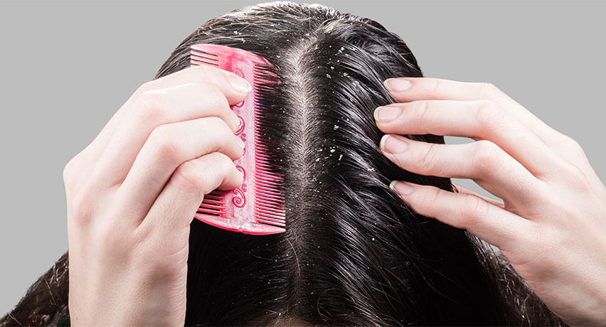 খুশকি থেকে মুক্তি পাওয়ার ঘরোয়া উপায়