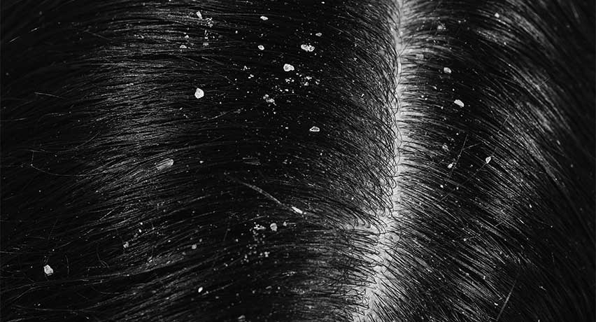 খুশকি দূর করার ঘরোয়া উপায়