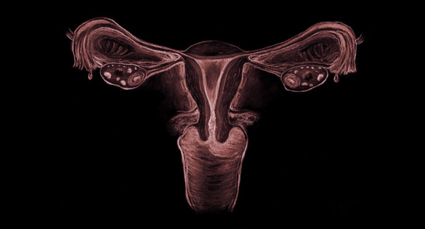 পলিসিস্টিক ওভারিয়ান সিন্ড্রোম (পিসিওস)- লক্ষণ, কারণ ও চিকিৎসা