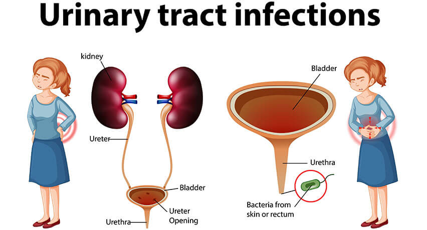 ইউরিনারি ট্র্যাক্ট ইনফেকশন