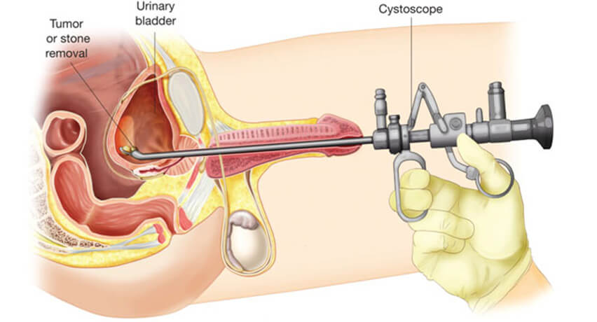 cystoscopy