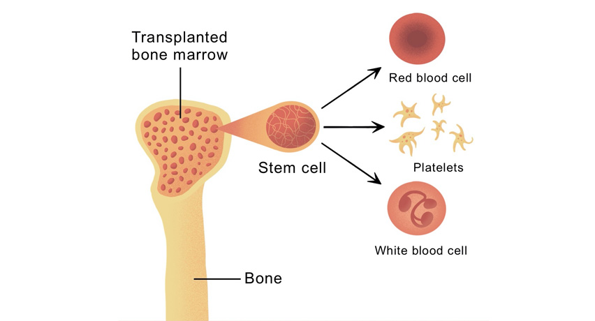 stem cell transplant