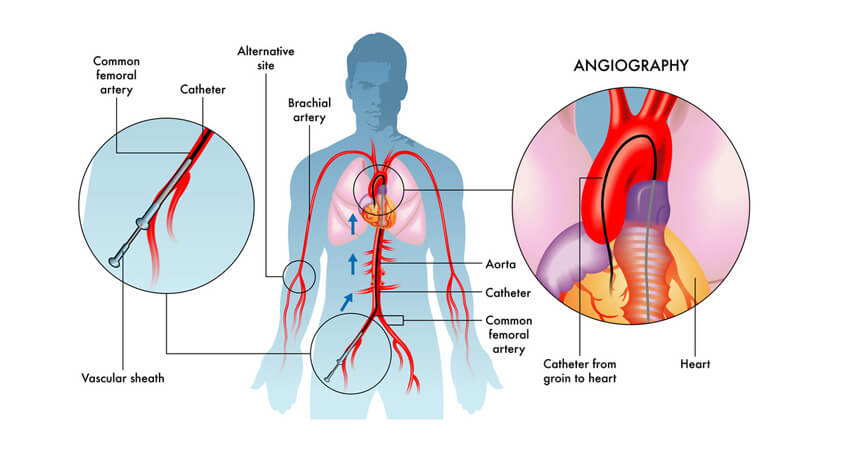 angiography