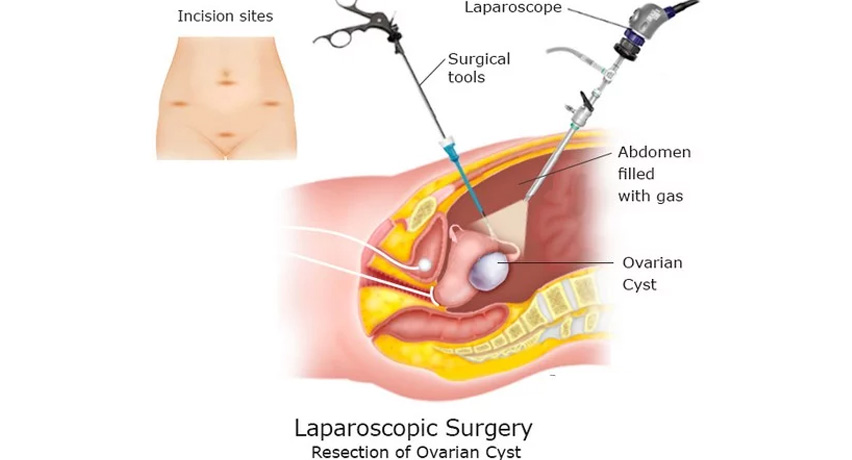 laparoscopy2