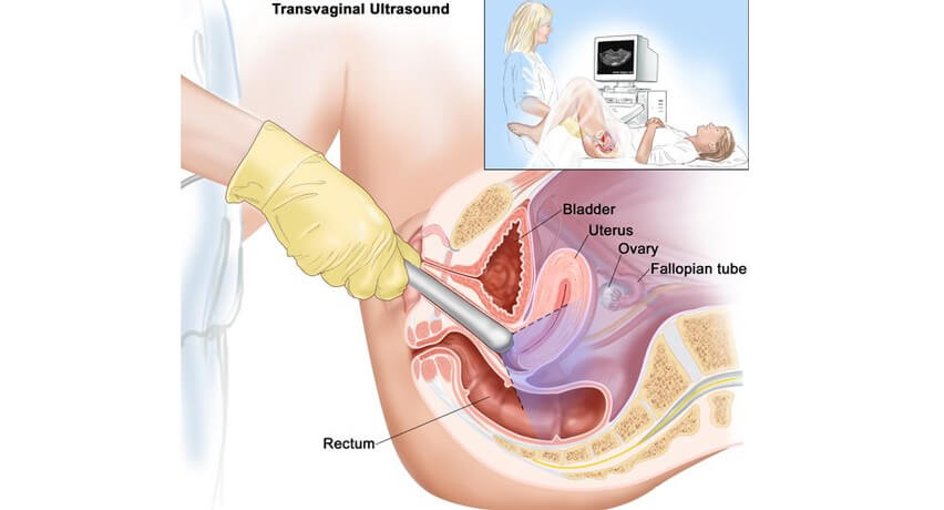 transvaginal